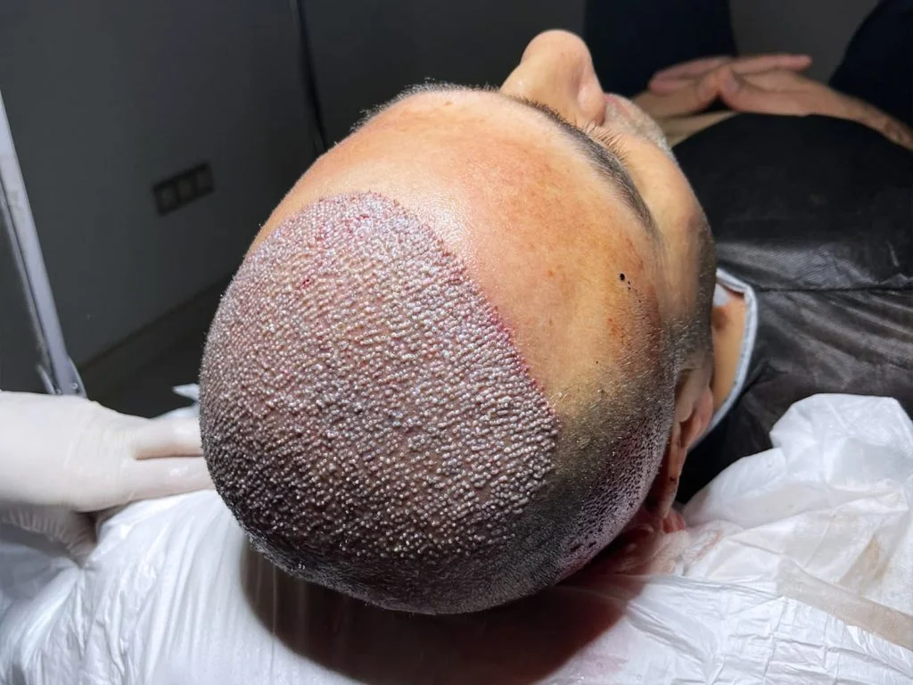 Trasplante Capilar (FUE y DHI) – New City Clinic