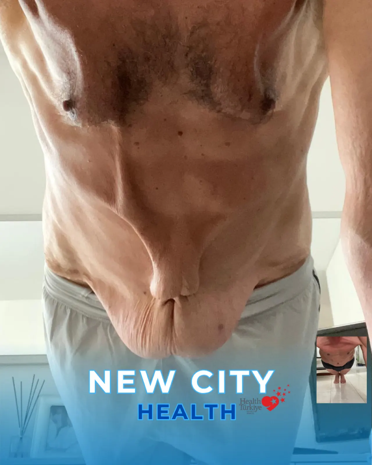 Abdomen - Before
