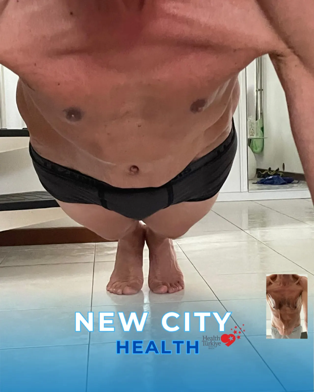 Abdomen - After