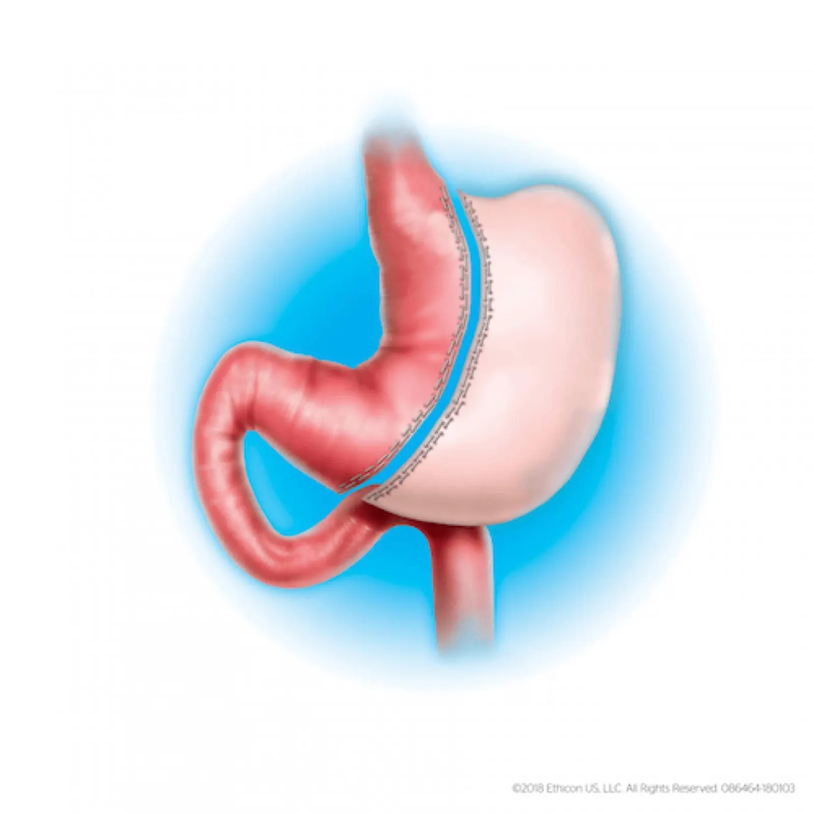 Cirugía Bariátrica (Manga y Bypass Gástrico) – New City Clinic