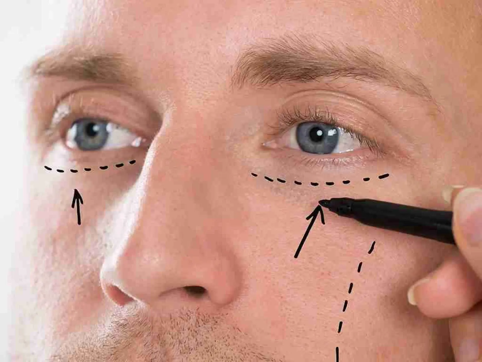 Blefaroplastia en Estambul – New City Clinic