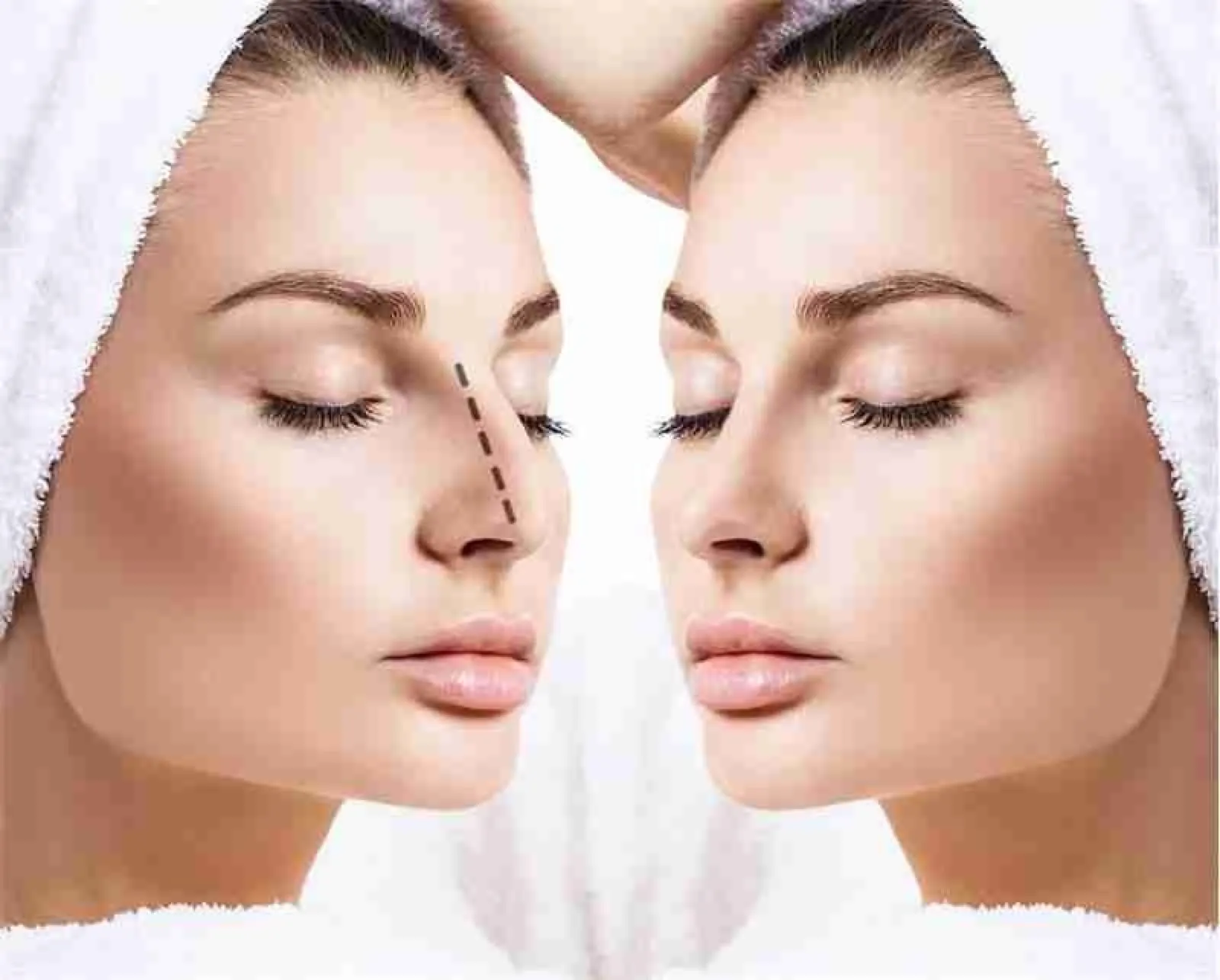 Rinoplastia – New City Clinic
