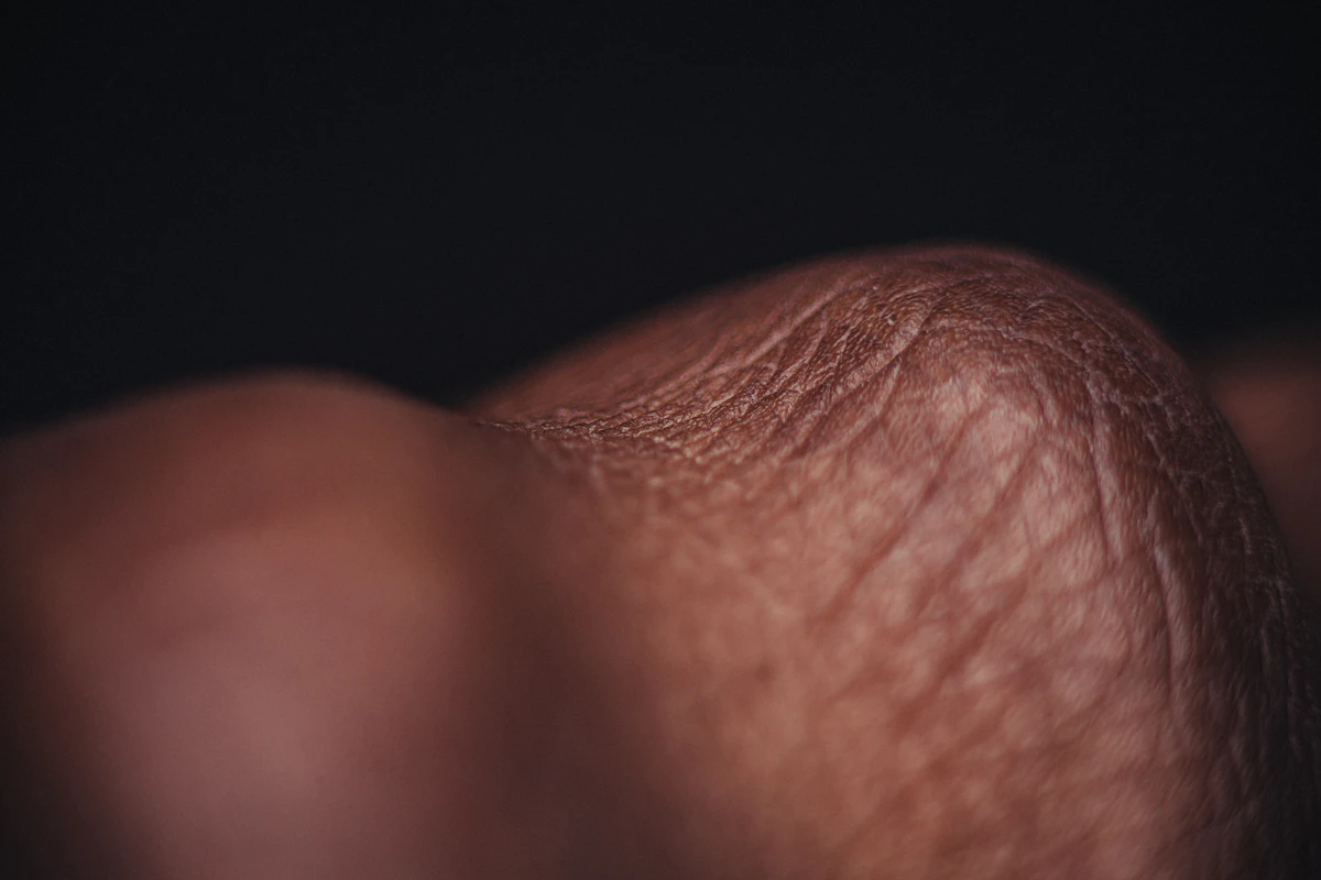 Scar Revision Surgery in Istanbul – New City Clinic