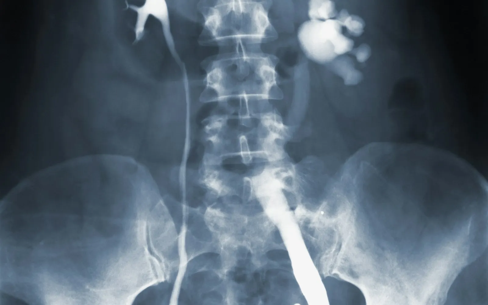 Herniated Disc: When Is Surgery Needed?