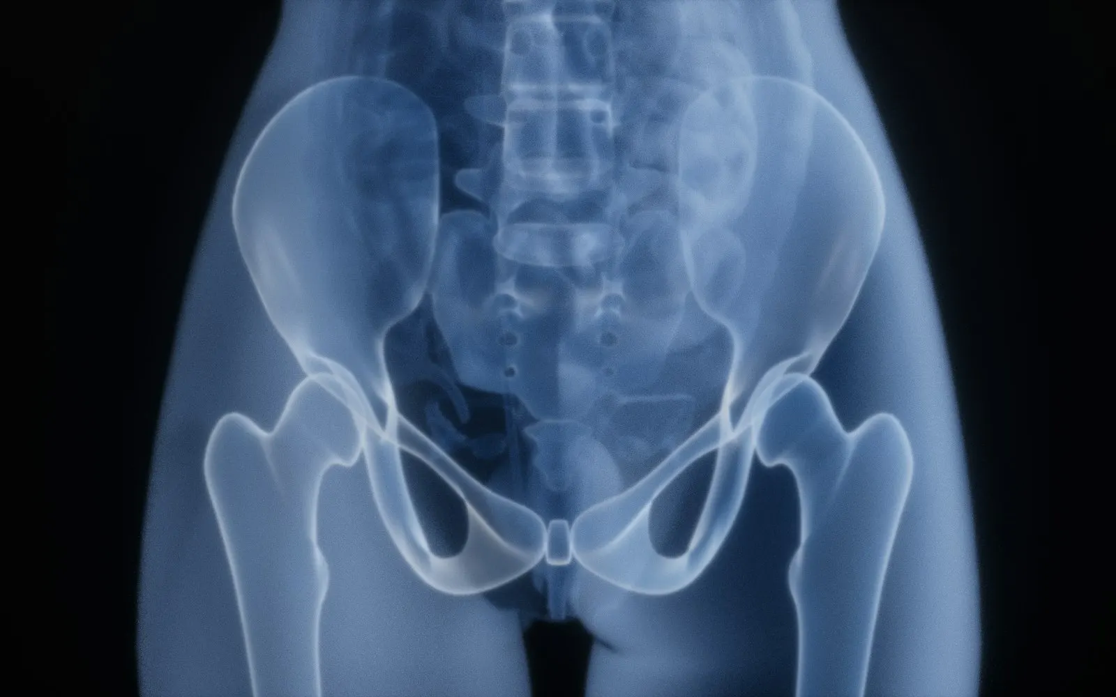 Hip Replacement in Istanbul – New City Clinic